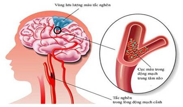 BỆNH ĐỘT QUỴ